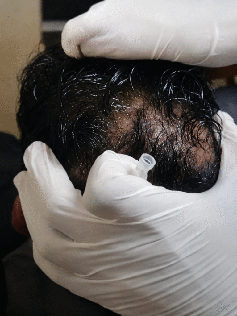 hair fall
