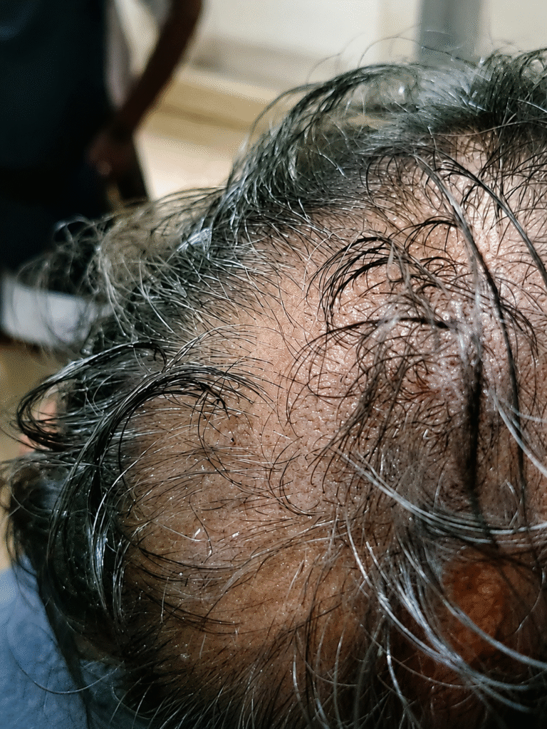 hairfall