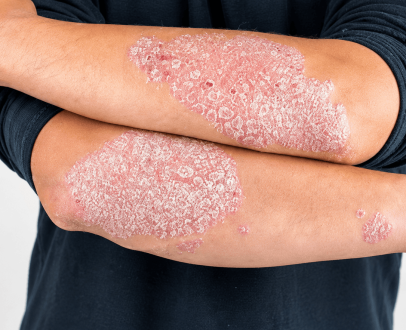 psoriasis